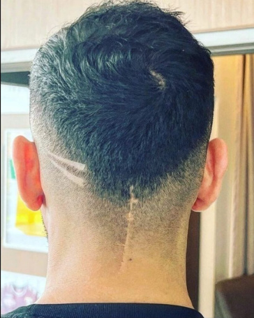 Cicatriz da cir