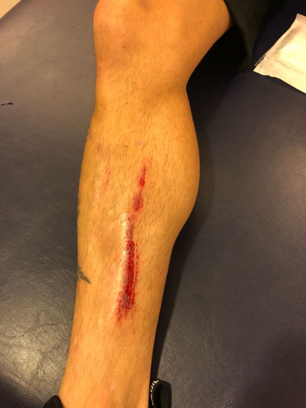 Entrada de Marlon deixou machucado nada agradável na canela de Fagner