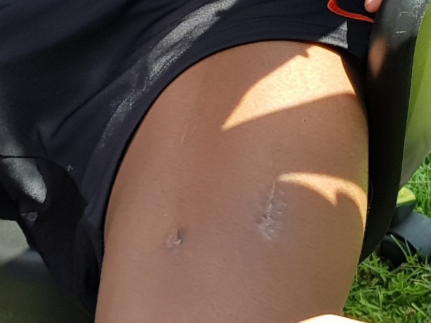 Ao lembrar de polêmica, o jogador mostrou cicatriz à imprensa