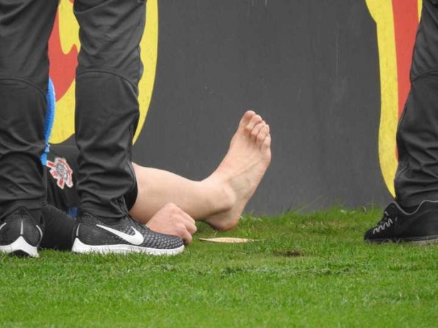 Imagem da perna de Caque Frana aps se machucar no treino